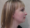 Rhinoplasty