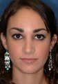 Rhinoplasty
