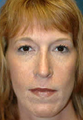 Rhinoplasty