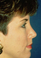 Rhinoplasty
