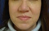 Rhinoplasty