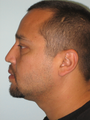 Nasal Reconstruction