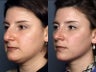 Nose Surgery