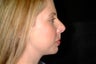 Rhinoplasty