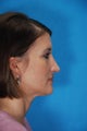 Rhinoplasty