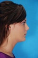Rhinoplasty (nose job, nasal surgery)