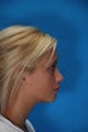 Rhinoplasty (nose job, nasal surgery)