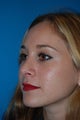 Nose Surgery