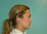 Rhinoplasty- Nose Job