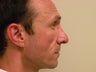 Rhinoplasty 