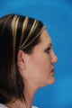 Rhinoplasty (nose job)