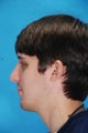 Rhinoplasty (nose job)