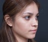 Nose Surgery