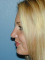 Rhinoplasty
