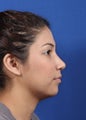 nasal airway surgery with cosmetic benefits