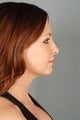 Closed Rhinoplasty