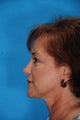Rhinoplasty (nose job)