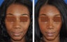 African American Rhinoplasty