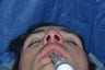 Closed Nasal Reduction (Resetting Broken Nose)
