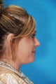 Rhinoplasty (nose job)