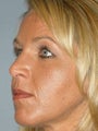 Rhinoplasty