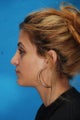 Rhinoplasty (nose job)
