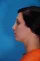 Rhinoplasty (nose job)