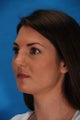 Rhinoplasty (nose job)