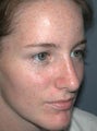 Rhinoplasty
