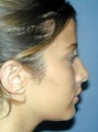Nose Surgery, Rhinoplasty