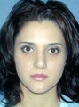 Nose Surgery, Rhinoplasty