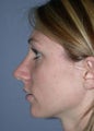 Rhinoplasty