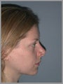 Nose Surgery, Rhinoplasty