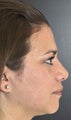 Nose Surgery