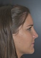 Rhinoplasty