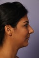 Nose Surgery