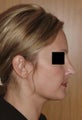 Rhinoplasty