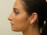Rhinoplasty