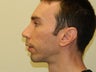 Rhinoplasty