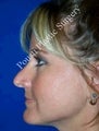 Rhinoplasty 