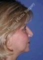 Rhinoplasty 