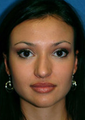 Rhinoplasty