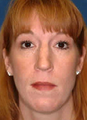 Rhinoplasty