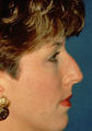 Rhinoplasty