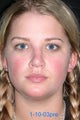 Rhinoplasty