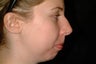 Rhinoplasty