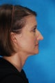 Rhinoplasty