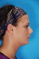 Rhinoplasty (nose job, nasal surgery)