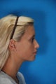 Rhinoplasty (nose job, nasal surgery)