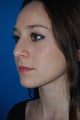 Nose Surgery
